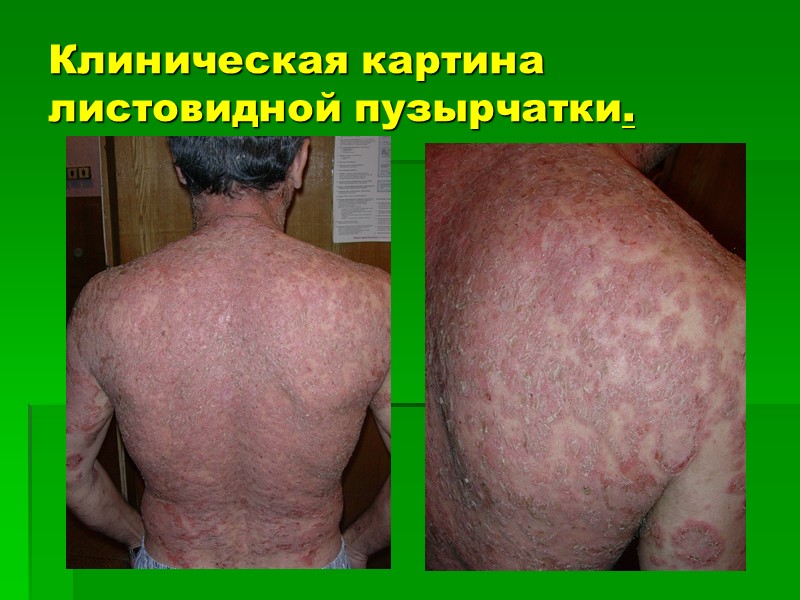 Клиническая картина листовидной пузырчатки.